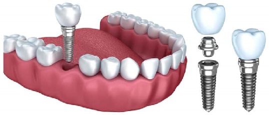 همه چیز درباره ایمپلنت دندان