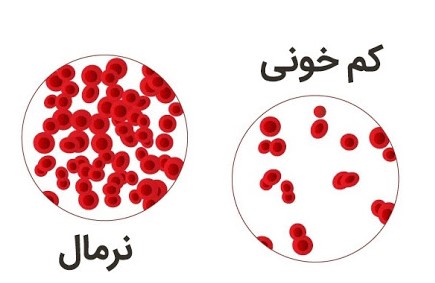 چگونه کم خونی ام را درمان کنم ؟