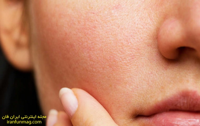 15 درمان خانگی موثر برای منافذ باز پوست
