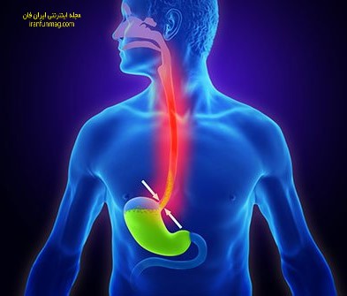 آیا سرکه سیب میتواند سوزش معده را درمان کند؟