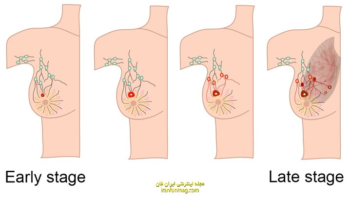 سرطان سینه