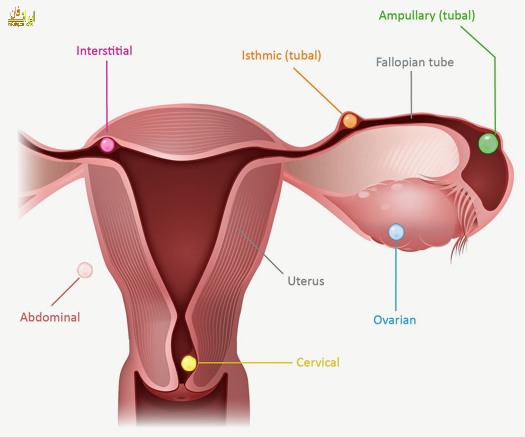 حاملگی خارج از رحم