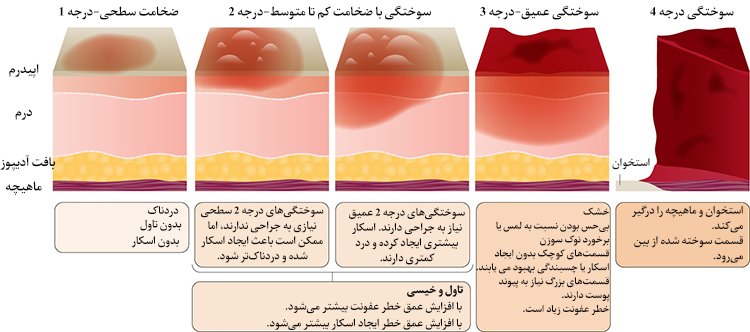  آشنایی با انواع درجه بندی سوختگی 