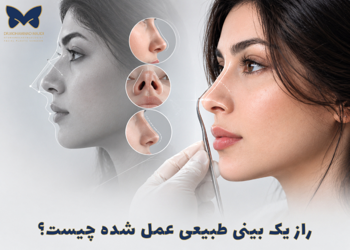 راز بینی طبیعی عمل شده چیست؟|دکتر محمد مجیدی