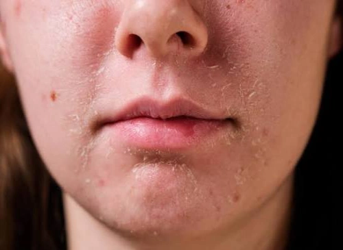 مهمترین نشانههای خشکی پوست